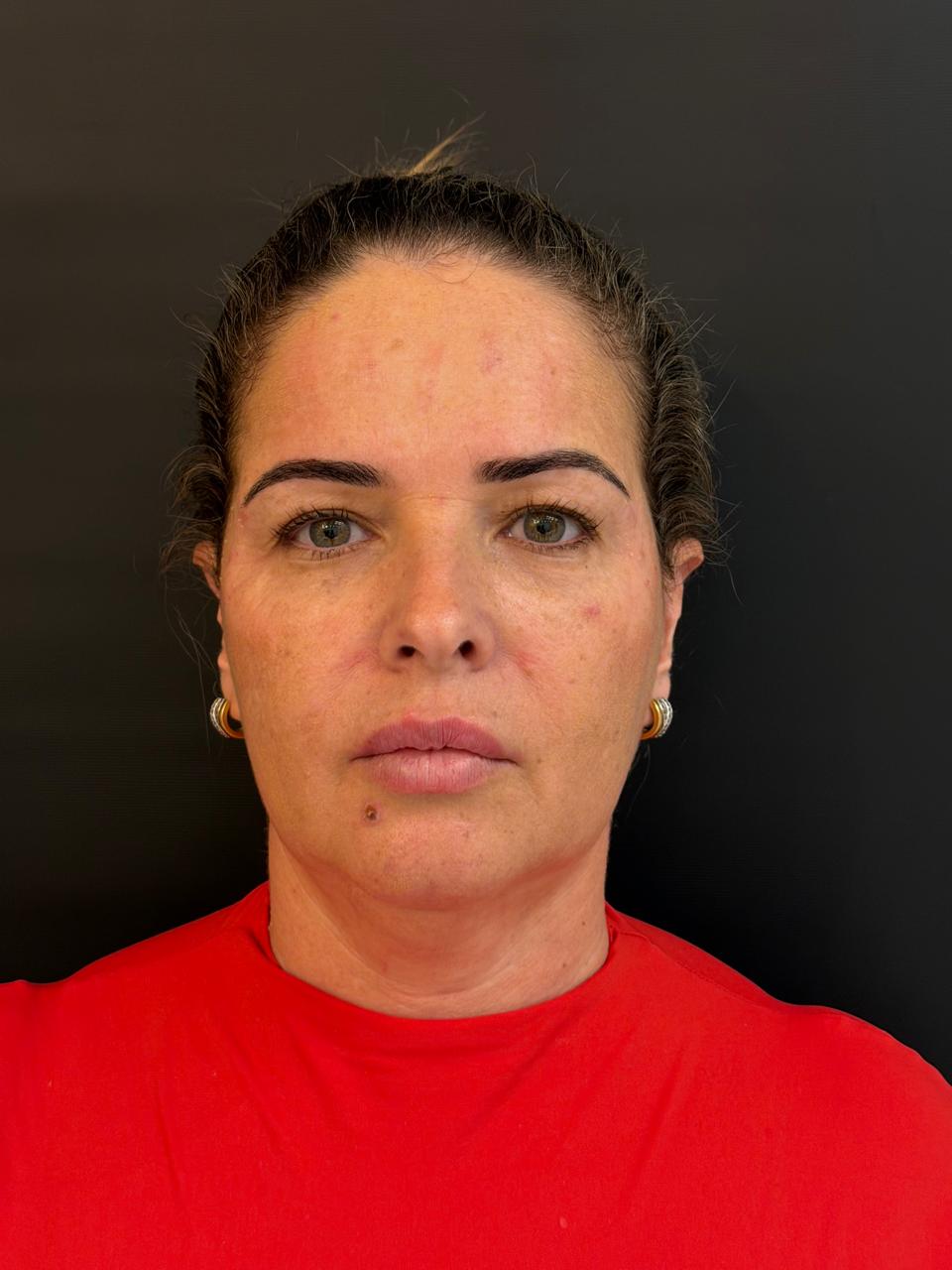 Rosto após a harmonização facial na Camarte Rio Clinic.