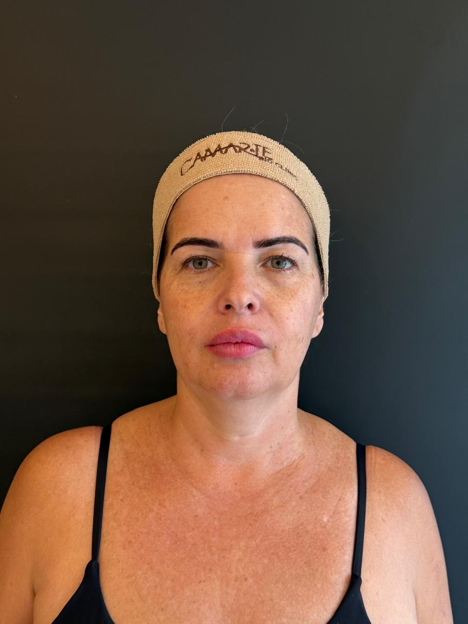 Rosto antes da harmonização facial na Camarte Rio Clinic.