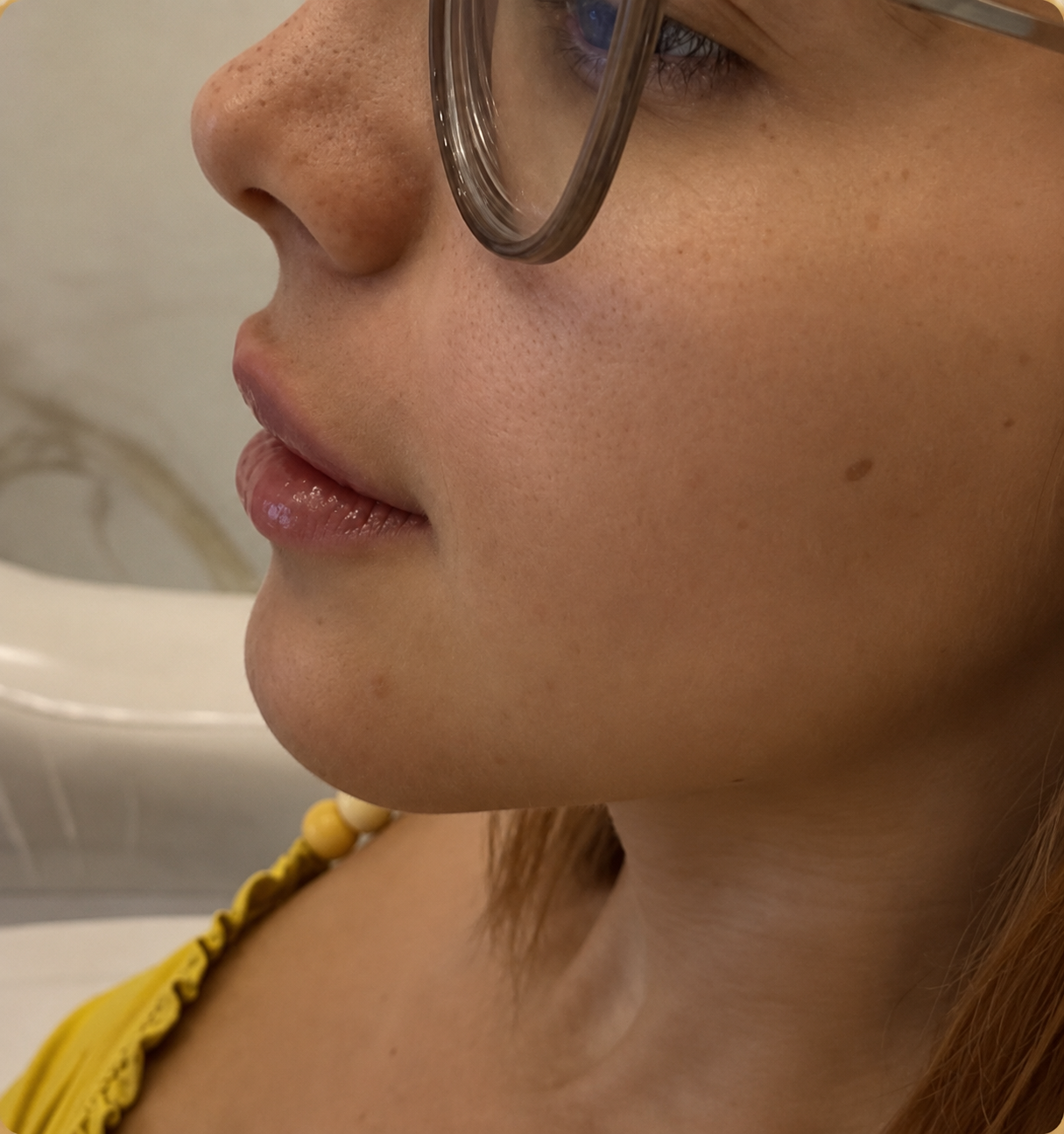 Perfil dos lábios após o preenchimento labial na Camarte Rio Clinic.
