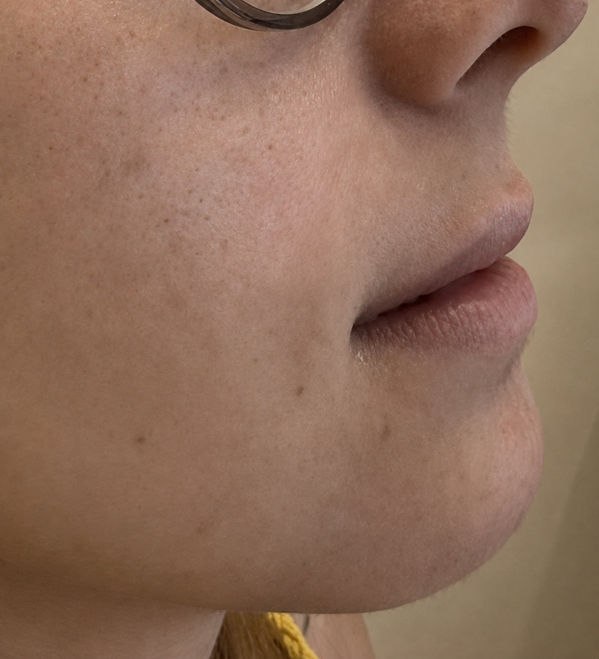 Perfil dos lábios antes do preenchimento labial na Camarte Rio Clinic.